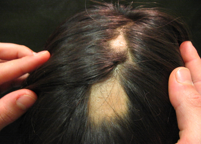 Caída de cabello. ¿Qué debemos saber?